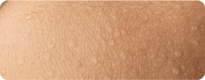 Dry Skin